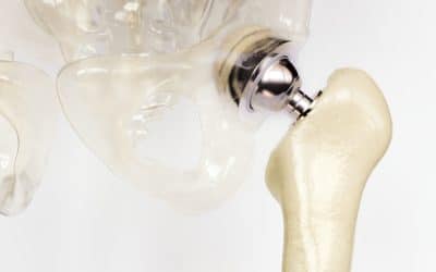 The Benefits of Electropolishing stainless steel for the Orthopedic Industry