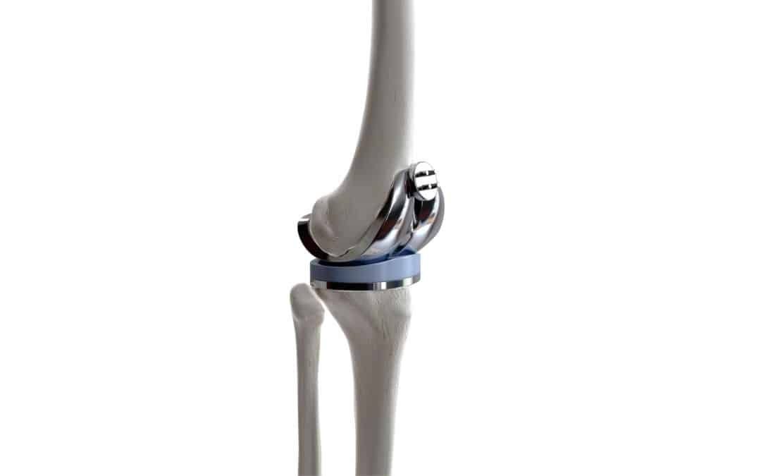 Ensuring Biocompatibility: Electropolishing and Orthopedic Devices
